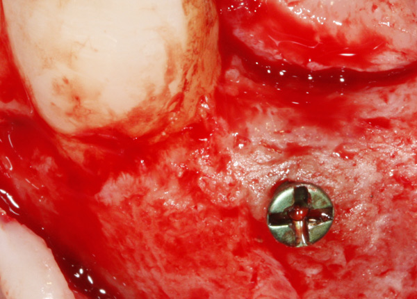 implante-curso-dentista-2